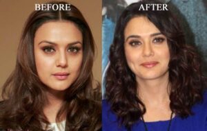 bollywood actress plastic surgery