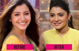 bollywood actress plastic surgery