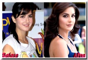 bollywood actress plastic surgery