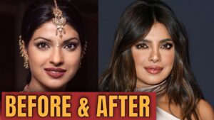 bollywood actress plastic surgery